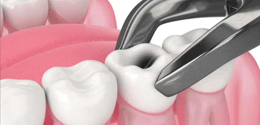 how do you calm down before tooth extraction
