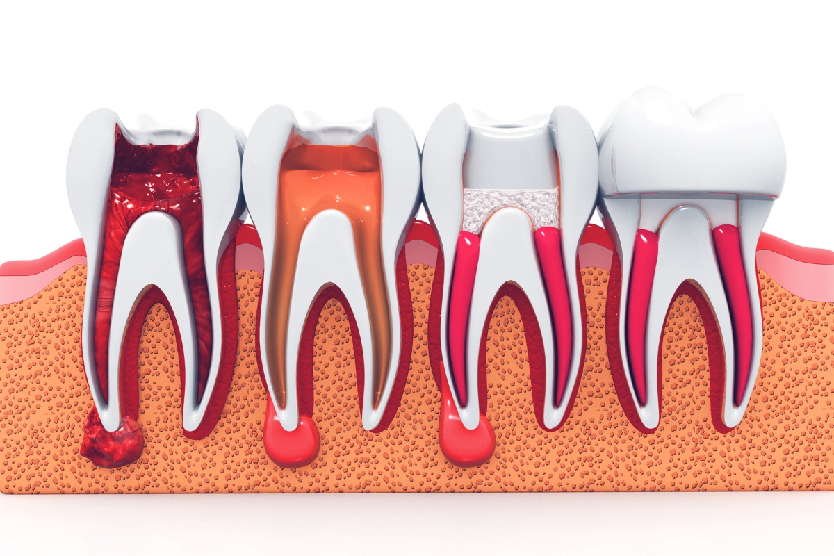 Root Canal Therapy Upland CA